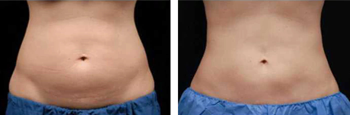 before & after photo of CoolSculpting