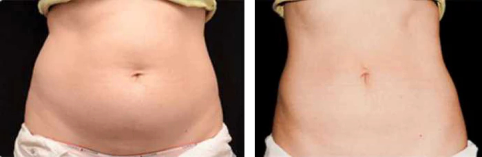 before & after photo of CoolSculpting