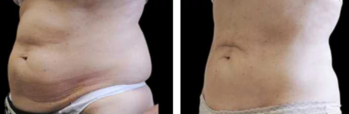 before & after photo of CoolSculpting