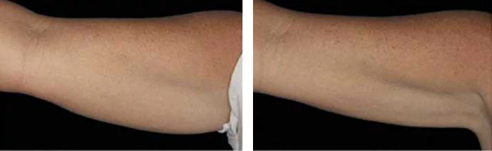 before & after photo of CoolSculpting