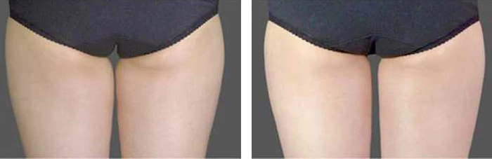 before & after photo of CoolSculpting
