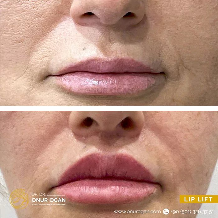 before & after photo of dermal-fillers