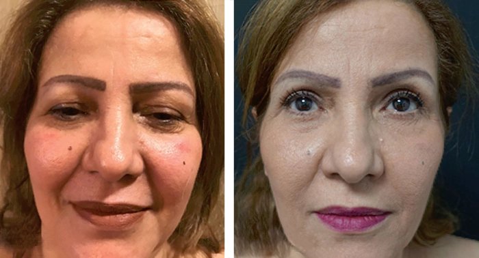 before & after photo of Dermal Fillers