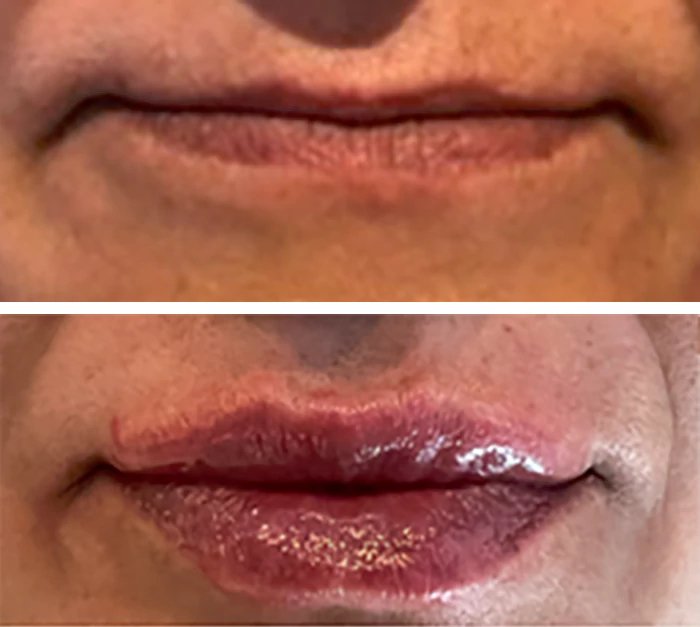 before & after photo of dermal-fillers