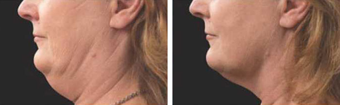 before & after photo of Double Chin Removal