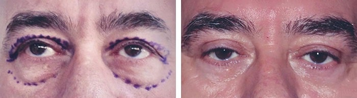 before & after photo of عملية تجميل الجفون