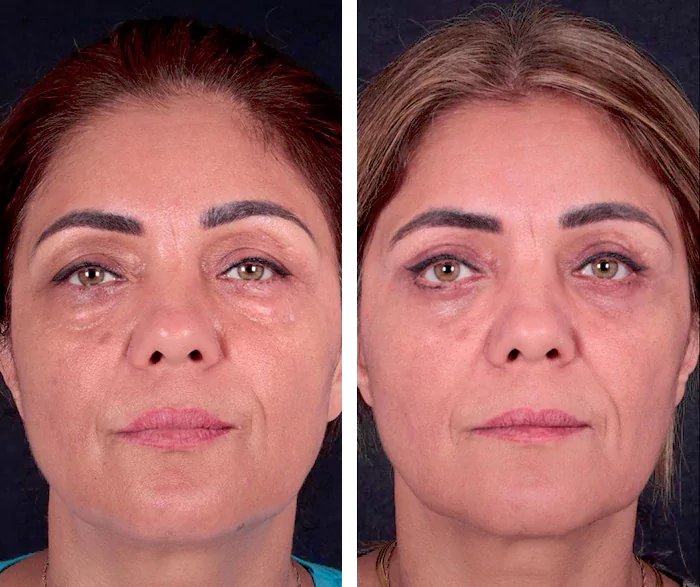 before & after photo of عملية تجميل الأنف