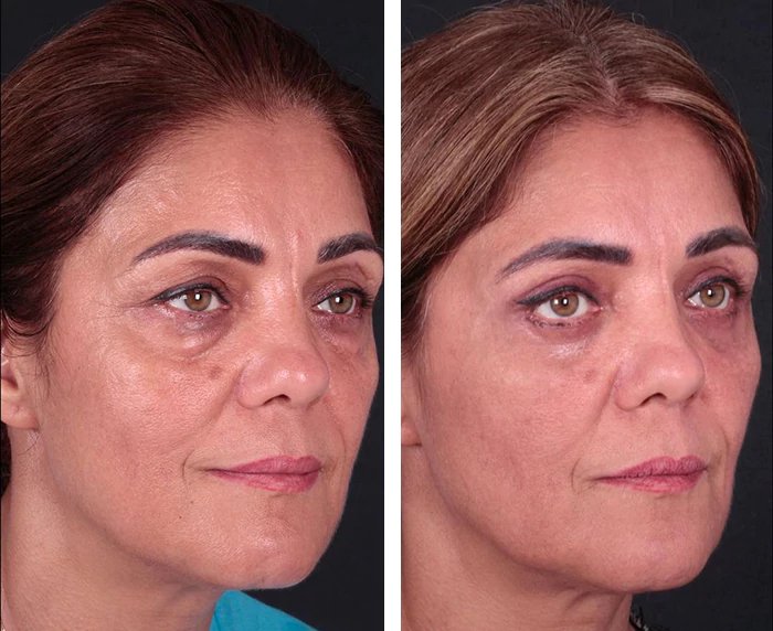 before & after photo of عملية تجميل الجفون