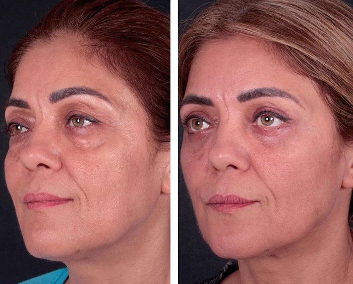 before & after photo of عملية تجميل الجفون