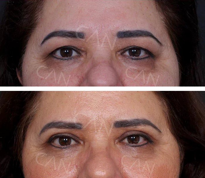 before & after photo of عملية تجميل الجفون