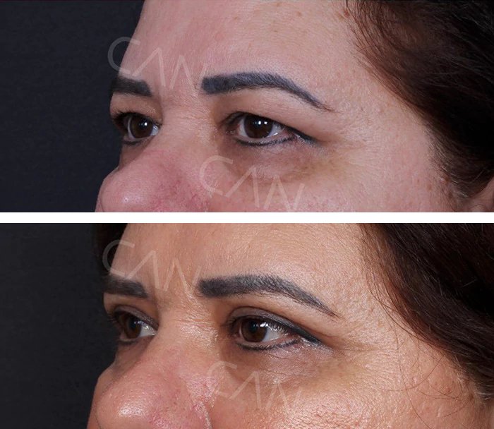 before & after photo of عملية تجميل الجفون