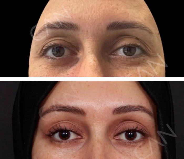 before & after photo of عملية تجميل الجفون