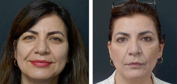 before & after photo of عملية تجميل الجفون