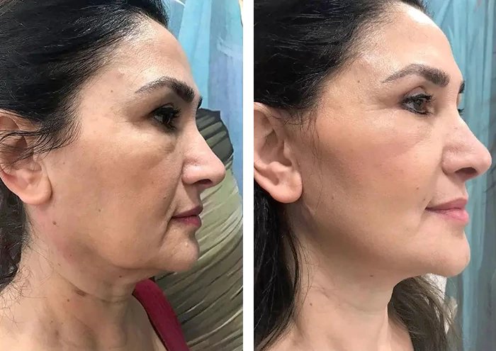 before & after photo of Rhinoplasty