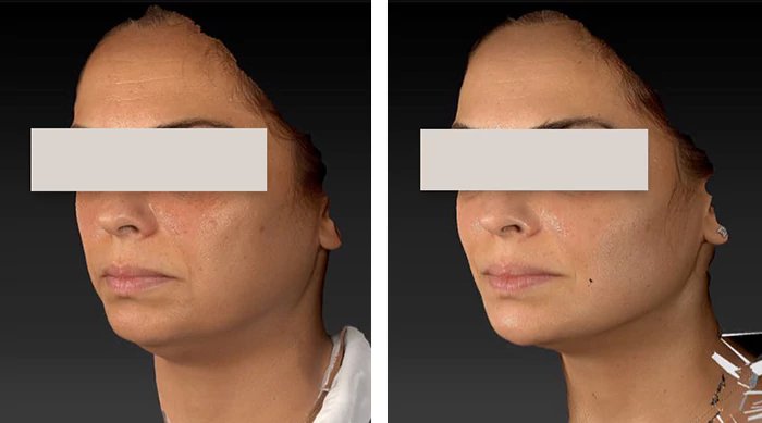 before & after photo of Chin and Jawline Filler