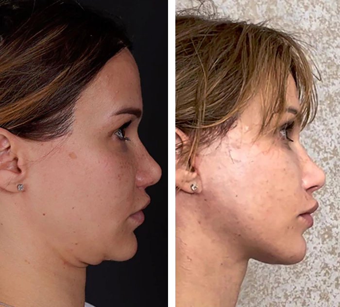 before & after photo of Rhinoplasty