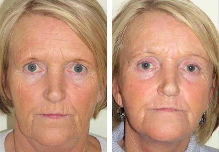 before & after photo of facelift