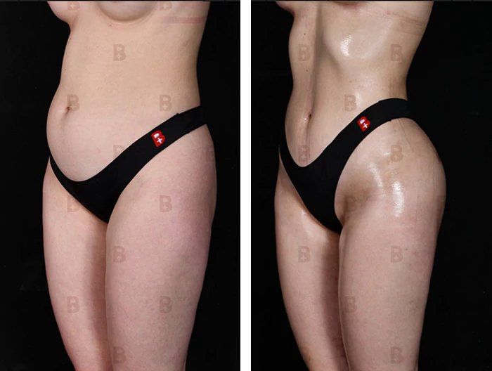 before & after photo of Body Lift