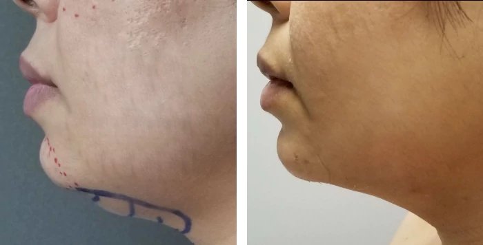 before & after photo of sliding-genioplasty