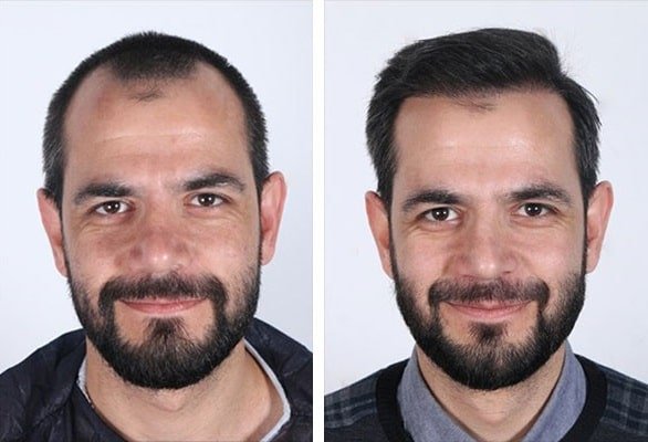 before & after photo of Hair Transplant