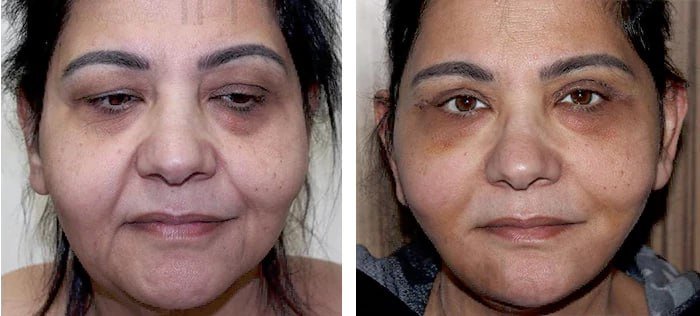 before & after photo of Facelift