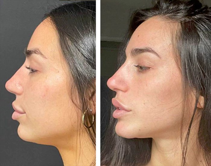 before & after photo of Chin and Jawline Filler