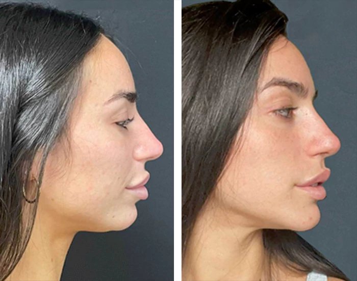 before & after photo of Chin and Jawline Filler