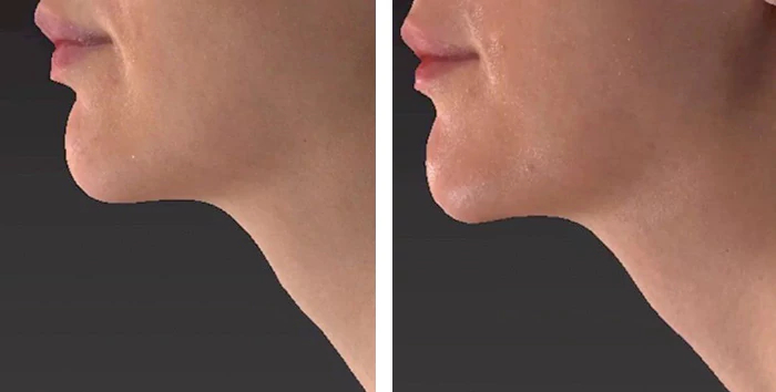 before & after photo of Chin and Jawline Filler