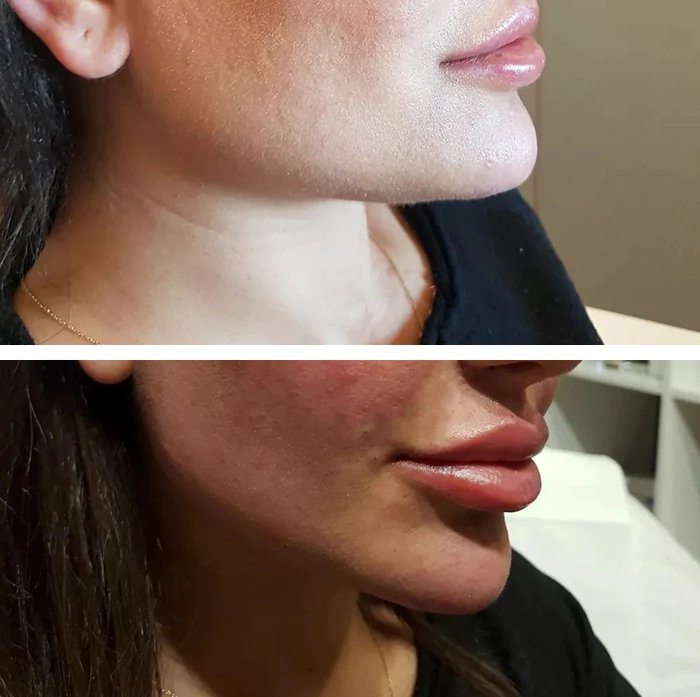 before & after photo of Nose Filler