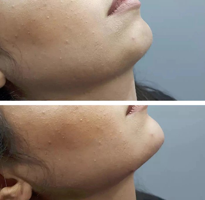 before & after photo of Nose Filler