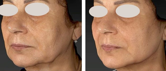 before & after photo of Chin and Jawline Filler