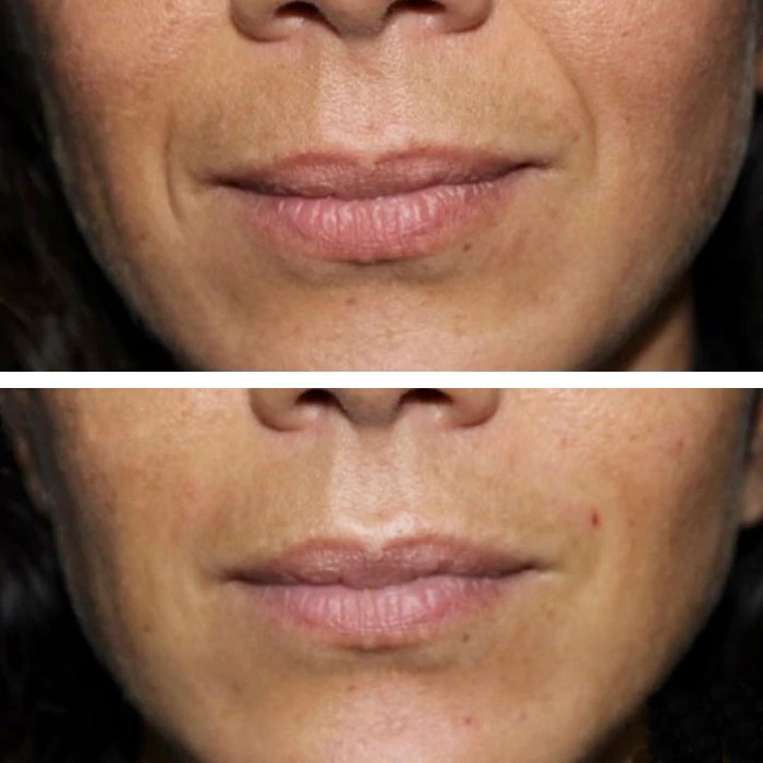 before & after photo of Chin and Jawline Filler