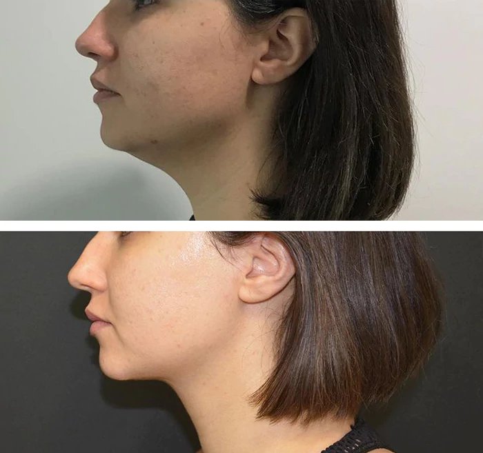 before & after photo of Rhinoplasty