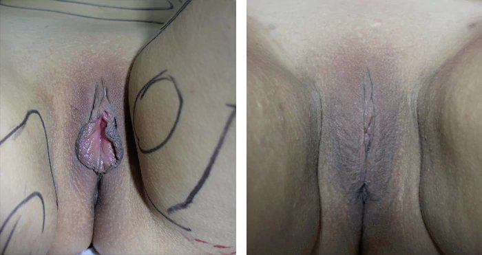 before & after photo of Labiaplasty