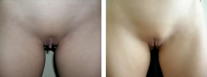 before & after photo of Labiaplasty