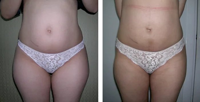 before & after photo of Liposuction