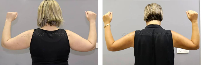 before & after photo of Arm Lift