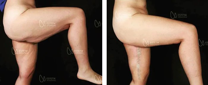 before & after photo of Thigh Lift