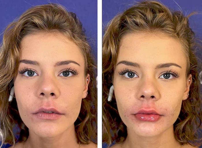 before & after photo of عملية تجميل الأنف