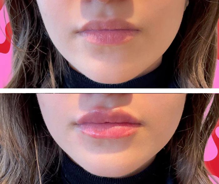 before & after photo of Lip Filler