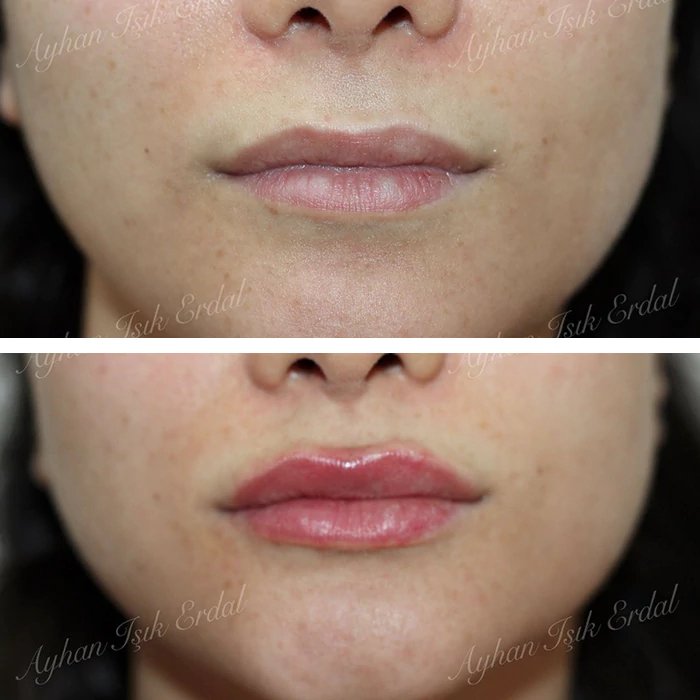 before & after photo of عملية تجميل الأنف