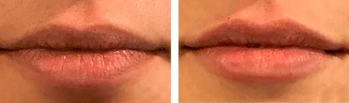 before & after photo of Lip Filler