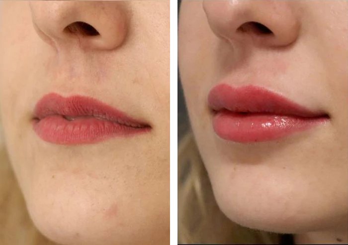 before & after photo of Nose Filler