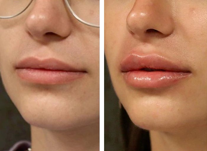 before & after photo of Nose Filler