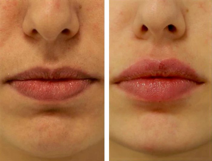 before & after photo of Nose Filler