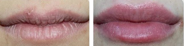 before & after photo of Chin and Jawline Filler