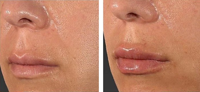 before & after photo of Chin and Jawline Filler