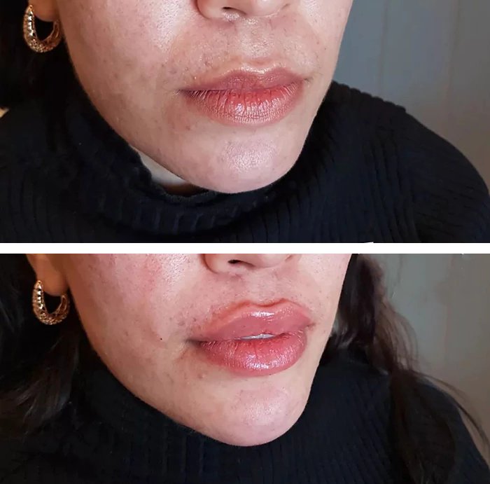 before & after photo of Nose Filler