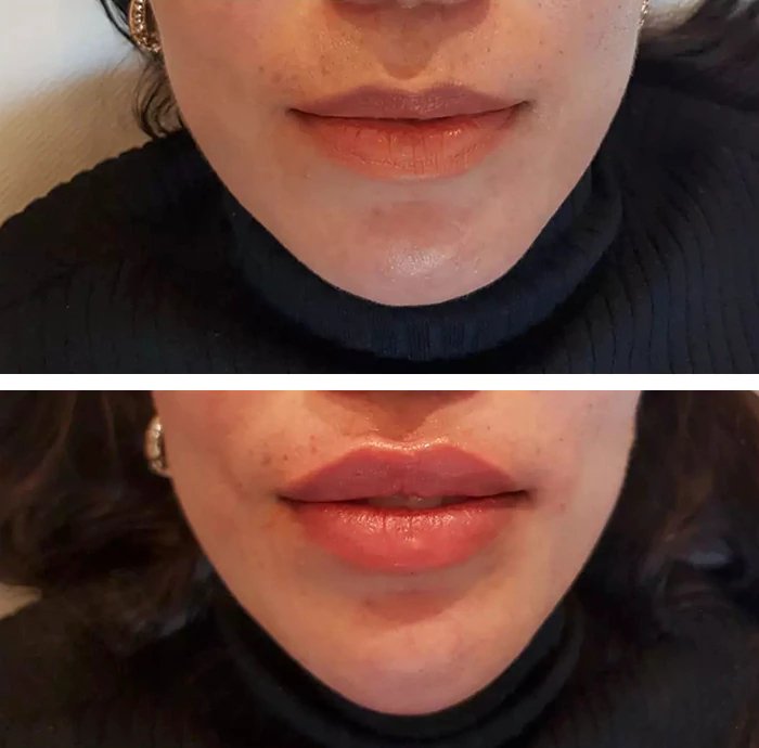 before & after photo of Nose Filler