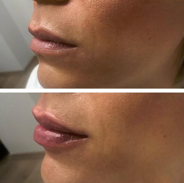 before & after photo of Lip Filler